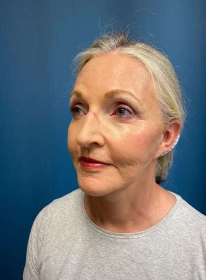 Facelift And Necklift Before & After Patient #1549
