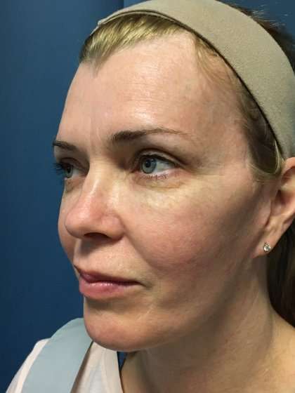 Facelift And Necklift Before & After Patient #1582