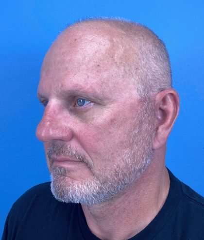 Facelift And Necklift Before & After Patient #1593