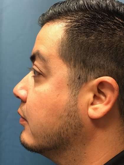 Chin Implant Before & After Patient #1604