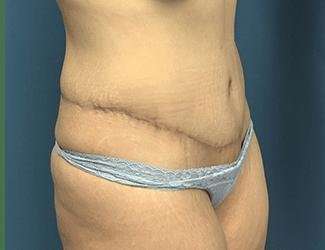Tummy Tuck Before & After Patient #369