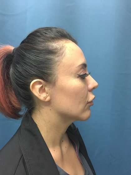 Chin Implant Before & After Patient #1611