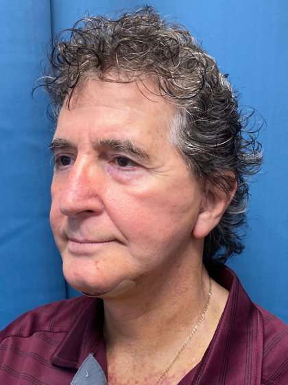 Chin Implant Before & After Patient #1633