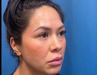 Buccal Fat Removal Before & After Patient #1643
