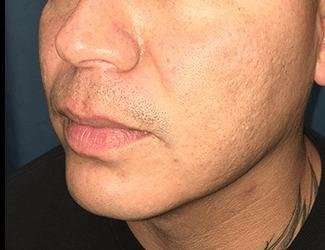 Buccal Fat Removal Before & After Patient #1656