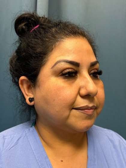 Buccal Fat Removal Before & After Patient #1663