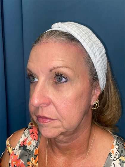 Brow Lift Before & After Patient #1694