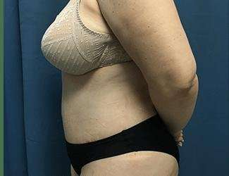 Tummy Tuck Before & After Patient #380
