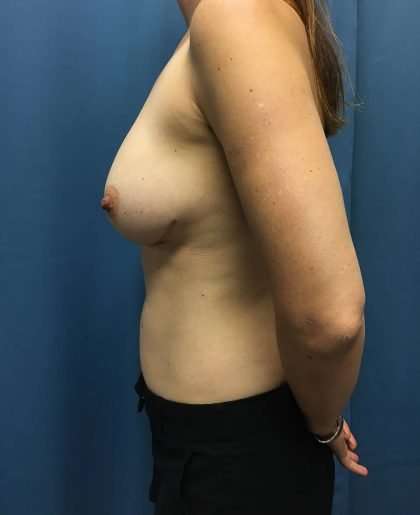 Breast Revision Before & After Patient #1716