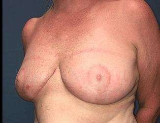 Breast Reduction Before & After Patient #1760
