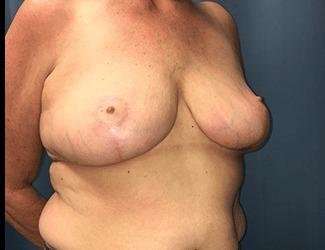 Breast Reduction Before & After Patient #1771