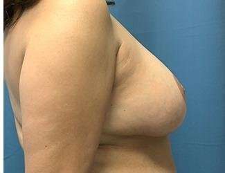 Breast Reduction Before & After Patient #1782