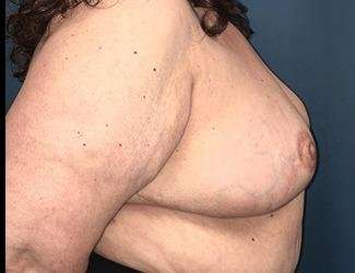 Breast Reduction Before & After Patient #1815