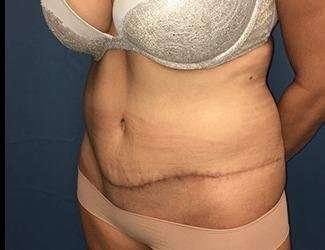 Tummy Tuck Before & After Patient #395
