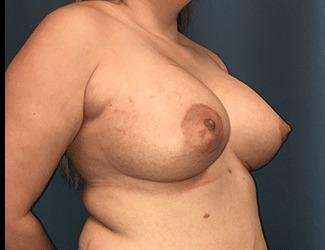 Breast Lift Before & After Patient #1903