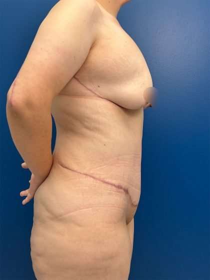 Tummy Tuck Before & After Patient #406