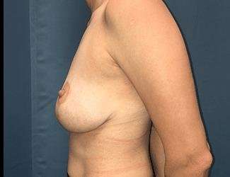 Breast Lift Before & After Patient #1923