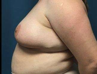 Breast Lift Before & After Patient #1934
