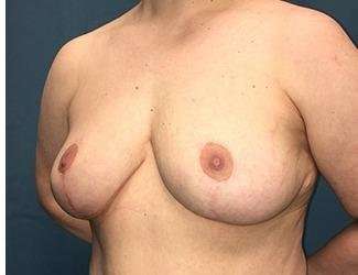 Breast Lift Before & After Patient #1945