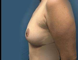 Breast Lift Before & After Patient #1965