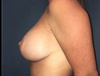Breast Lift Before & After Patient #1989