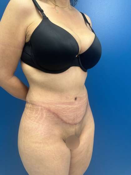 Tummy Tuck Before & After Patient #417