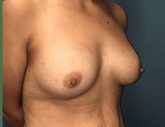 Breast Augmentation Before & After Patient #2091