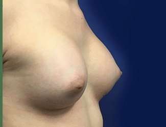 Breast Augmentation Before & After Patient #2102