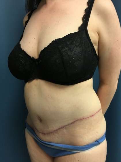 Tummy Tuck Before & After Patient #428
