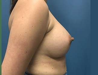Breast Augmentation Before & After Patient #2133