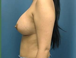 Breast Augmentation Before & After Patient #2153