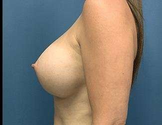 Breast Augmentation Before & After Patient #2191