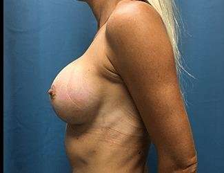 Breast Augmentation Before & After Patient #2202