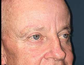 Blepharoplasty Before & After Patient #2251