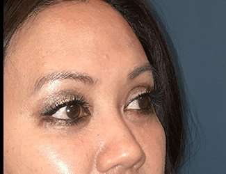 Blepharoplasty Before & After Patient #2260