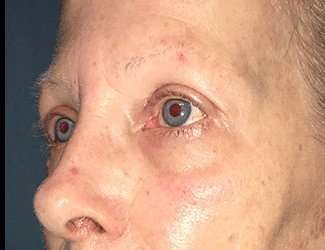 Blepharoplasty Before & After Patient #2271