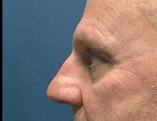 Blepharoplasty Before & After Patient #2282