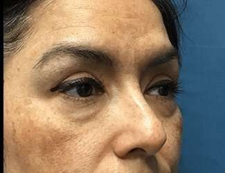 Blepharoplasty Before & After Patient #2293
