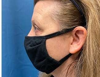 Blepharoplasty Before & After Patient #2308