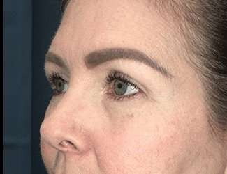 Blepharoplasty Before & After Patient #2315