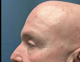 Blepharoplasty Before & After Patient #2328
