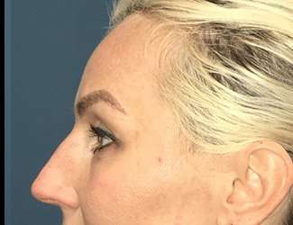Blepharoplasty Before & After Patient #2339