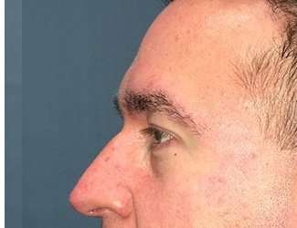 Blepharoplasty Before & After Patient #2352
