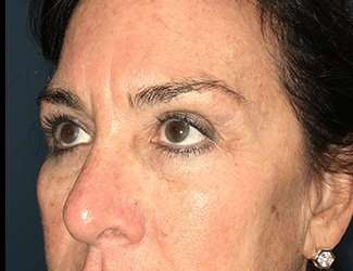 Blepharoplasty Before & After Patient #2368