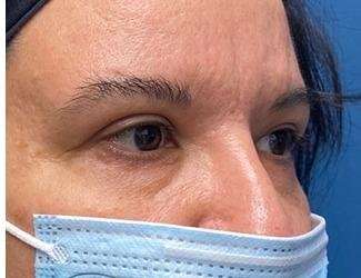Blepharoplasty Before & After Patient #2385
