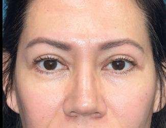 Blepharoplasty Before & After Patient #2390