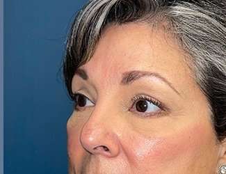 Blepharoplasty Before & After Patient #2397