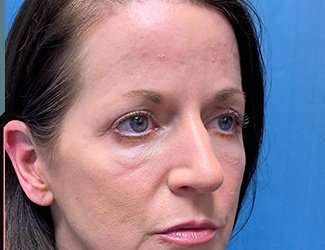 Blepharoplasty Before & After Patient #2408
