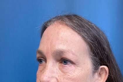 Blepharoplasty Before & After Patient #2419