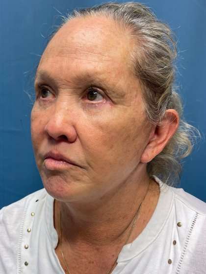 Blepharoplasty Before & After Patient #2430